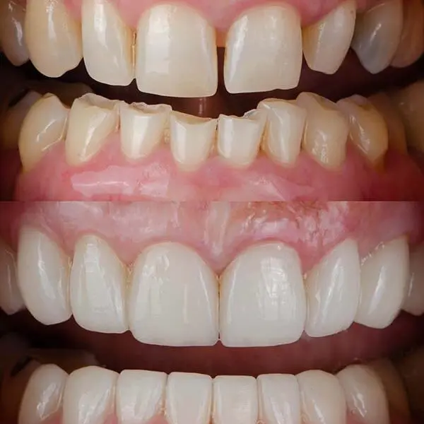 Veneers and whitening cosmetic dentist Houston
