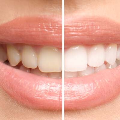 Houston teeth whitening